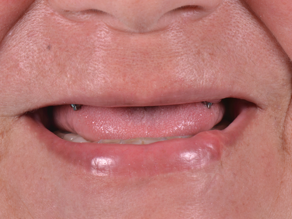 Antes del tratamiento: primer plano de la dentadura con el espacio de la pieza faltante