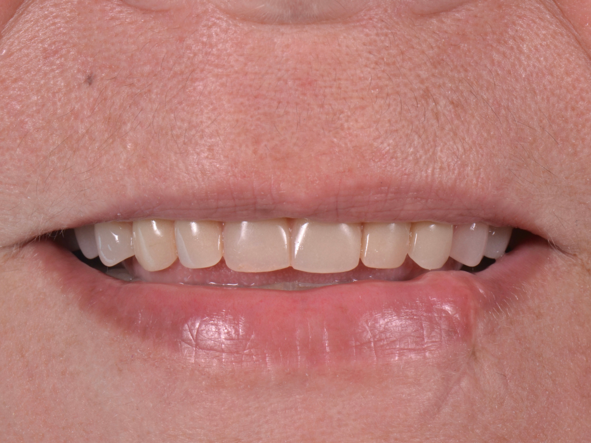 Después del tratamiento: primer plano de la dentadura con el implante y su corona